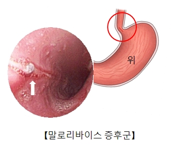 말로리바이스증후군