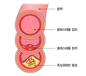 고콜레스테롤혈증